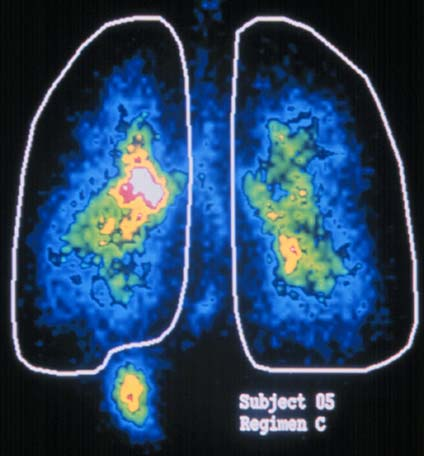 Deposición pulmonar con Turbuhaler La deposición pulmonar de fármaco con Turbuhaler es aproximadamente 38 42%, Con Accuhaker tiende a ser menor, alrededor de un 1 15%.