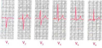 Las derivaciones electrocardiográficas torácicas (precordiales): V 1 -V 6 V 1 y V 2 los QRS son predominantemente negativos, porque el electrodo +