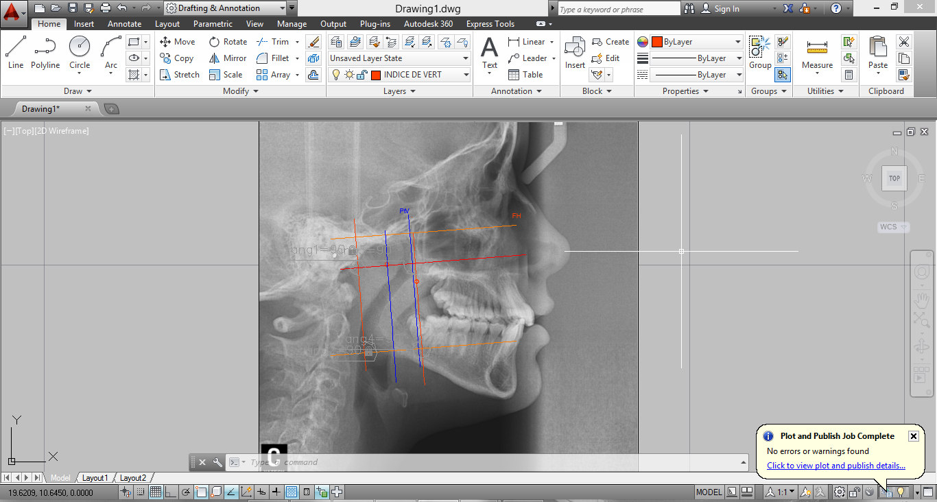 Altura facial inferior, Arco mandibular) como se puede observar en la Imagen Nº 8 y Tabla (Tab. Nº1), hallando así el biotipo facial.
