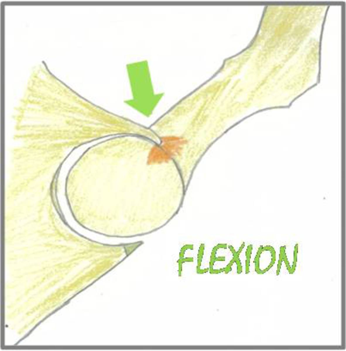 Fig. 7: Choque de la prominencia acetabular anterior con la unión