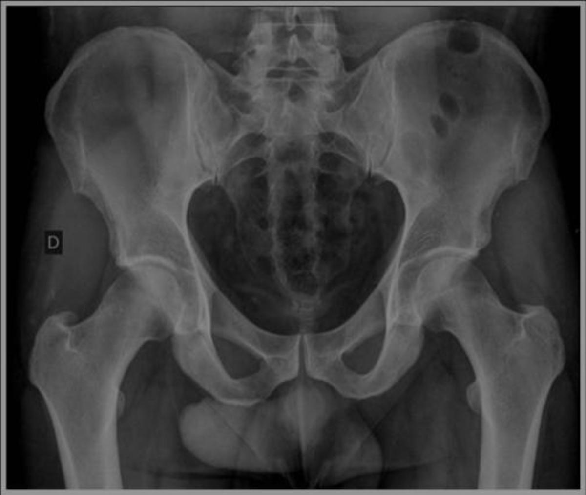 Fig. 9: Sobrecobertura focal acetabular posterior con edema óseo a nivel de