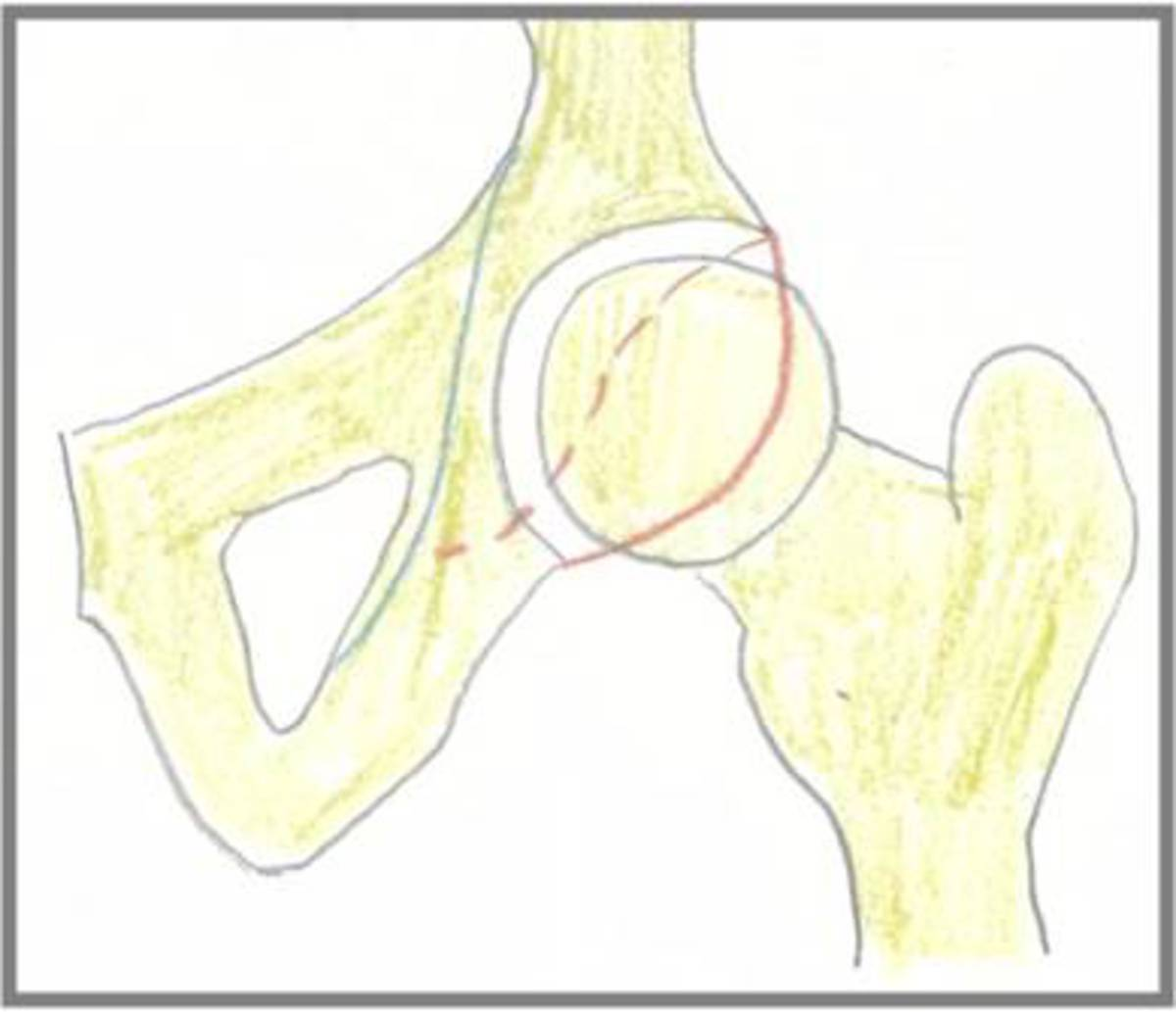Fig. 25: Sobrecobertura focal posterior: El reborde acetabular