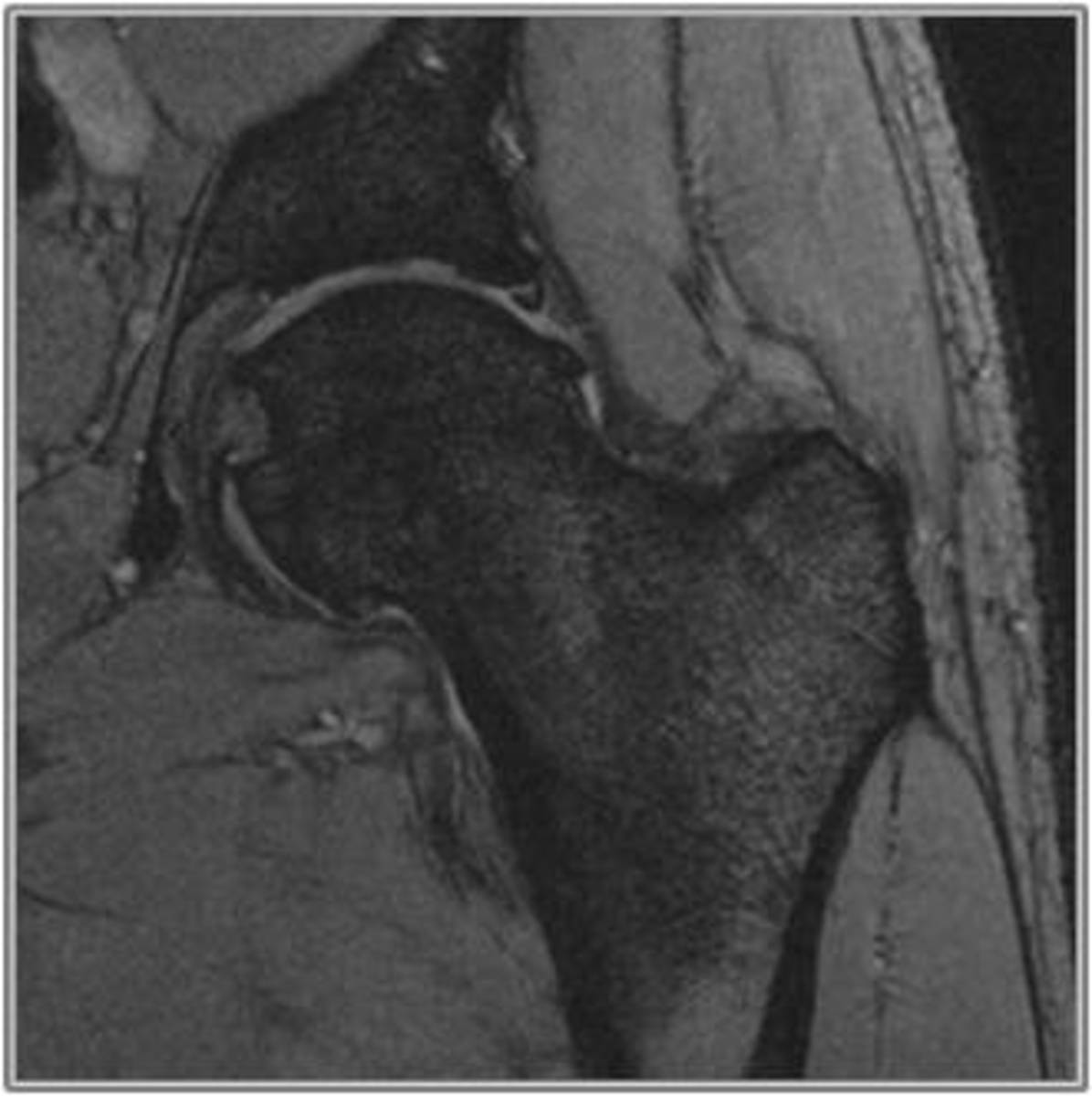 Fig. 52: Rotura degenerativa a nivel del ligamento de Teres, en paciente con