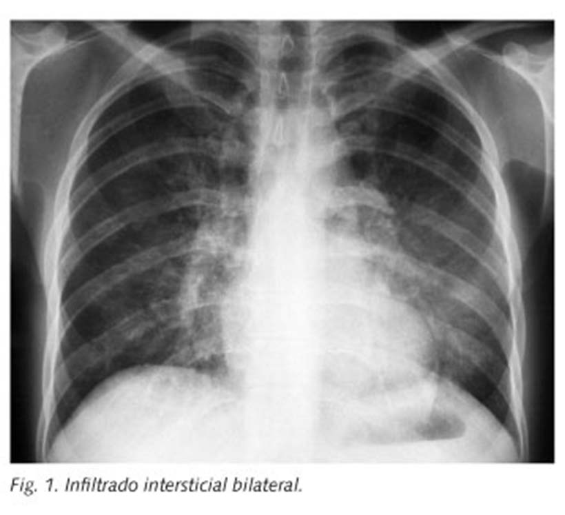 Introducción La pneumonía por Pneumocystis (PCP) es una enfermedad grave causada por el hongo Pneumocystis jirovecii.
