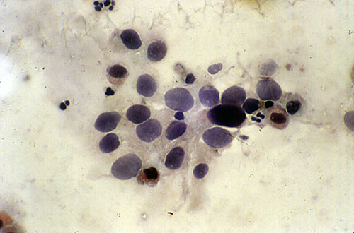 Si los hematíes son altos se buscará, el cilindro eritrocitario que señalará el origen glomerular de la hematuria.