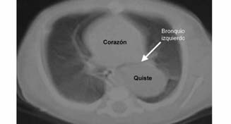 Quezada SCA, Navarrete AM. Figura 3. Radiografía lateral de tórax con imagen radio opaca redondeada, hacia mediastino posterior, las flechas señalan el contorno anterior de la lesión.