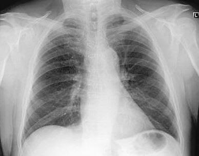Radiografía de tórax: Un sistema Ascending Aorta Trachea Aortic Knob Carina Hilum Descending Aorta Heart Mediastino : tráquea, carina, la aorta, el corazón y hilio - Anomalías