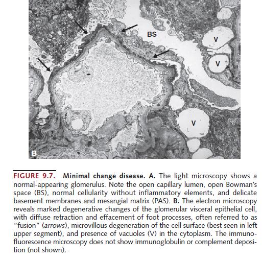 PATRÓN NEFRÓTICO Mecanismo NO INFLAMATORIO de daños a la pared capilar Lesión directa de los podocitos (Glomerulopatía de cambios mínimos, FSGS).