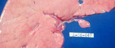 Figura 26 Una de las características de los pacientes con glucogenosis tipo I es el aumento de tamaño del hígado debido a la acumulación del glucógeno.