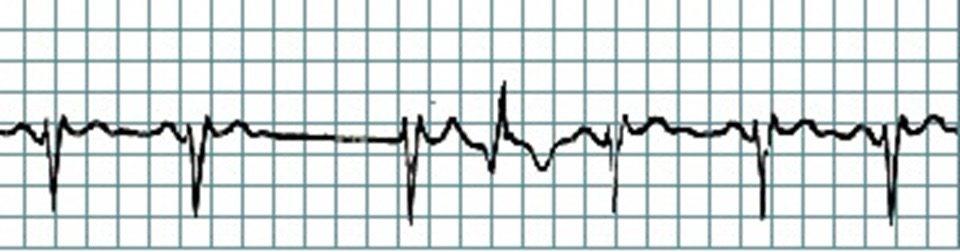 Figura 1. Ritmo sinusal ritmo sinusal normal Figura 2. Arritmia sinusal o respiratoria Figura 3.
