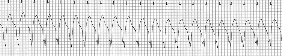 Monitorización con tres electrodos: DI, DII, DIII 1) Monitorizar el ritmo cardiaco: 2)