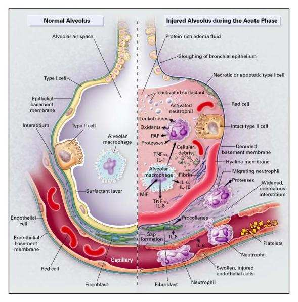 El Alveolo Normal Alveolo Dañado durante la Fase Aguda de Lesión Pulmonar Aguda y SDRA.