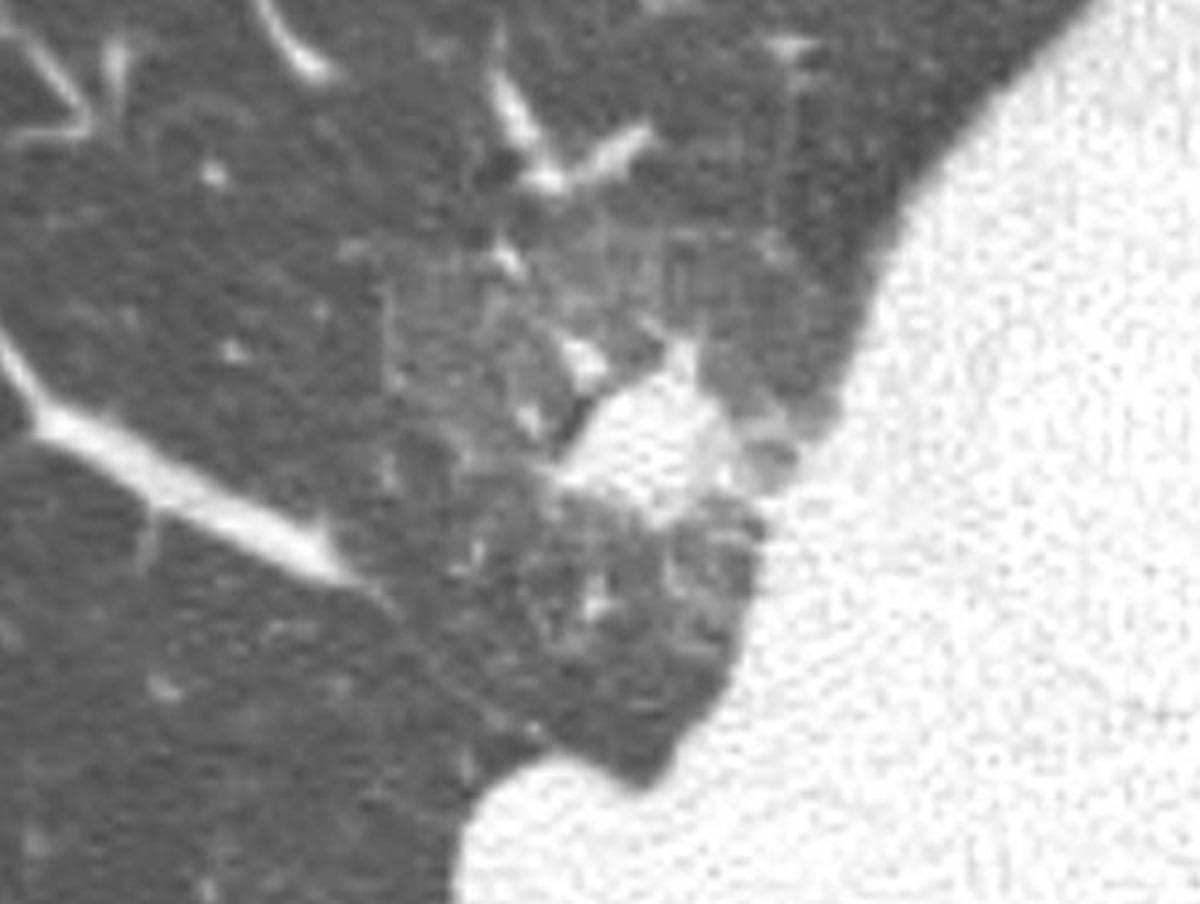 Fig. 7: 46 años, EPOC, fumador y bebedor: Micobacteria Atípica+aspergiloma Patrón destructivo en ambos lóbulos