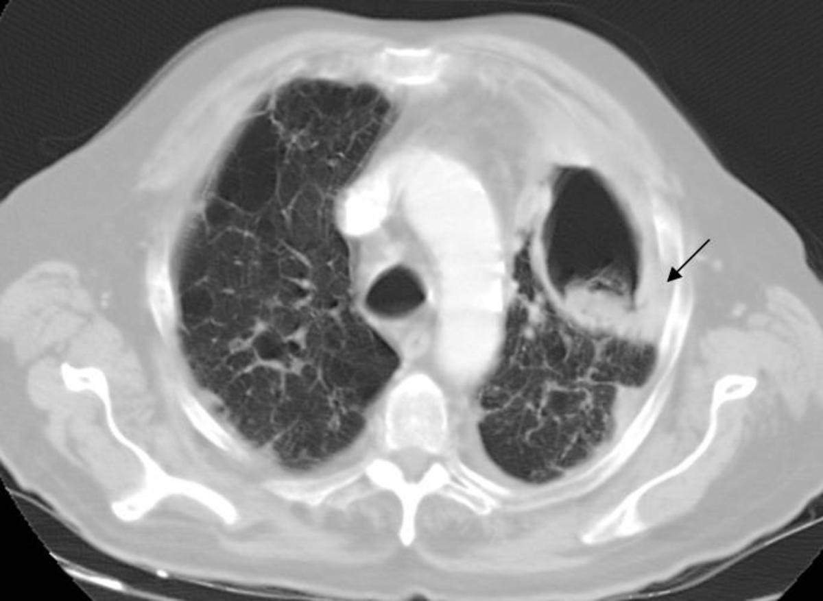 Fig. 11: Aspergiloma en varón de 78 años con metástasis pulmonares.