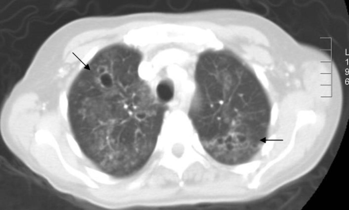 Fig. 19: El mismo paciente. Corte axial de TC tórax ventana pulmón.