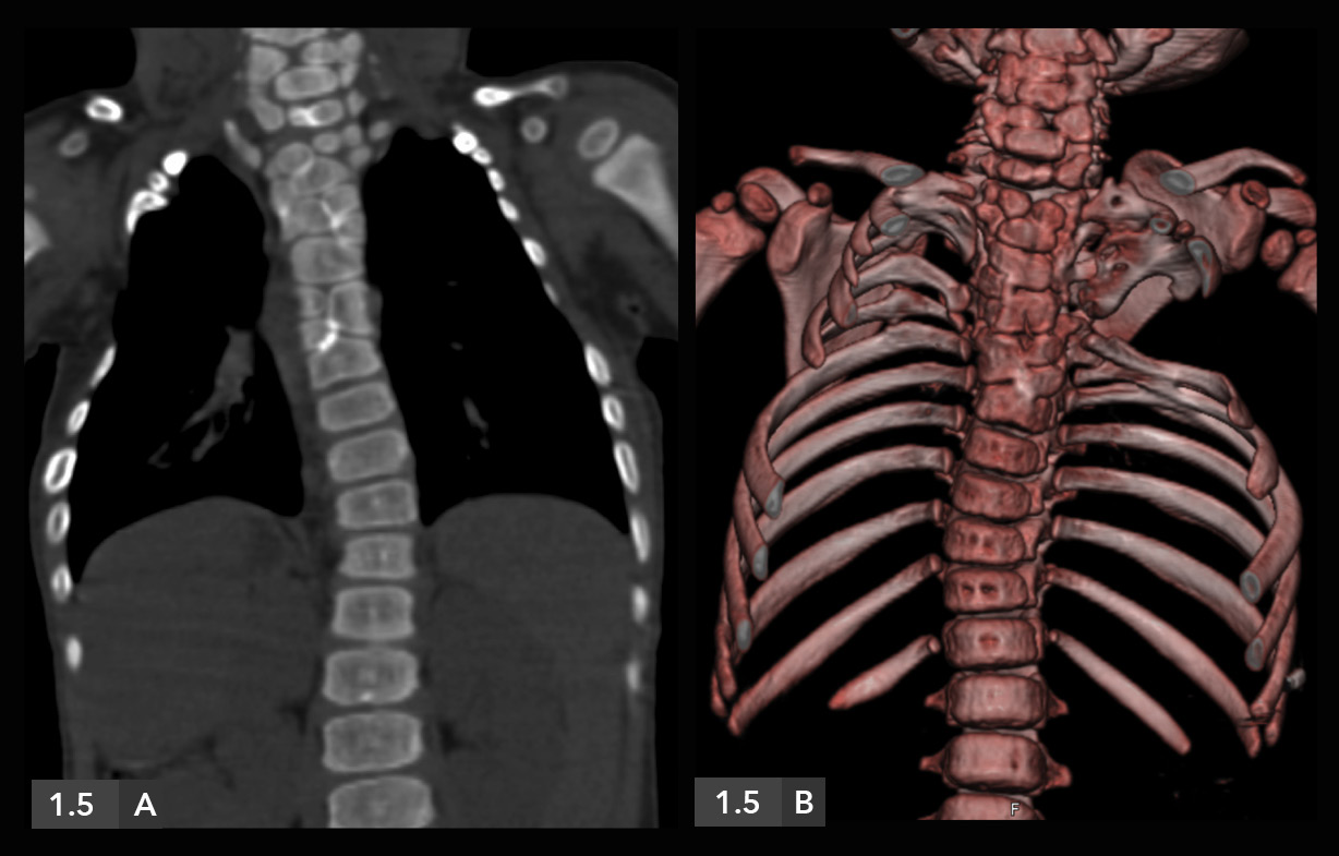 Columna vertebral / Anomalías congénitas / Raquis torácico 1.2. RAQUIS TORÁCICO Caso 1.4. Hemivértebra Historia clínica: Paciente joven con dolor mecánico y escoliosis. 1.4. Hemivértebra Figura 1.
