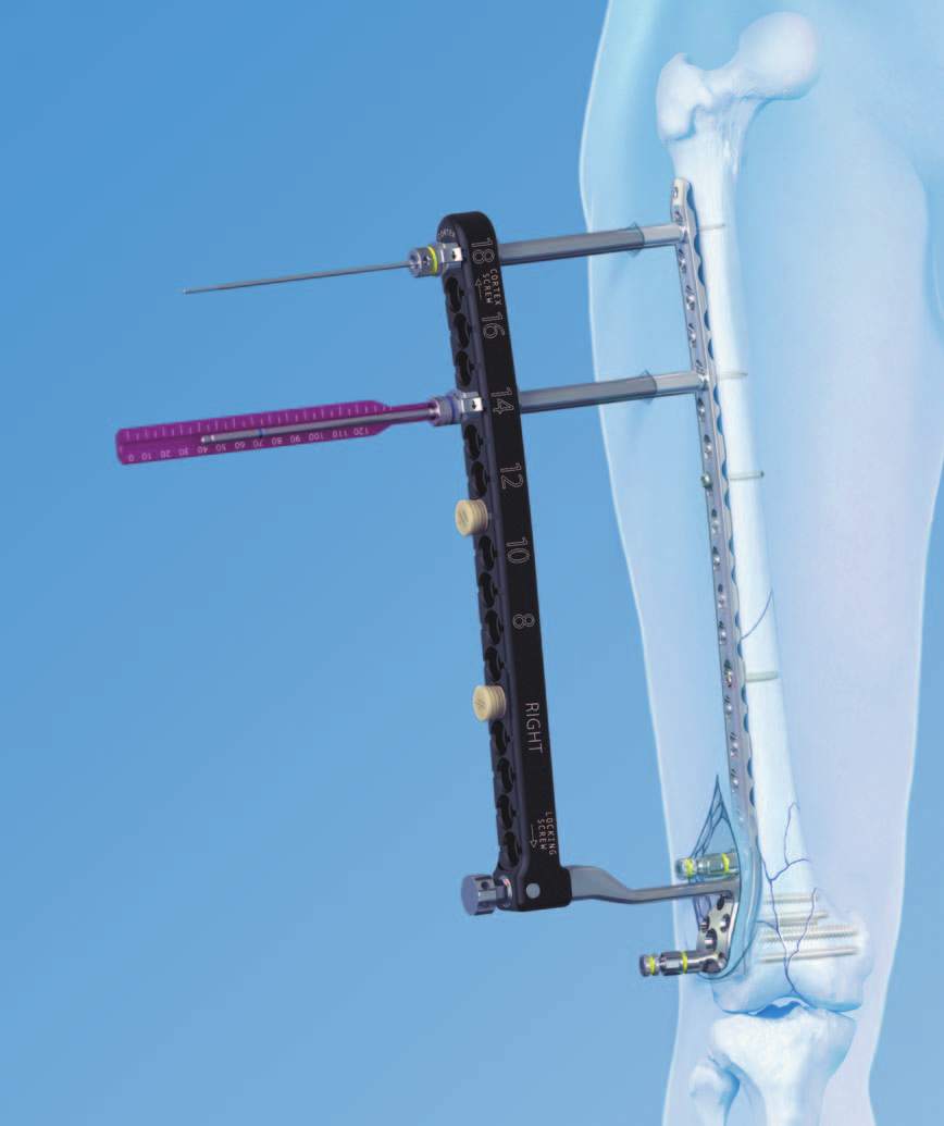 Técnica quirúrgica Instrumentos de arco de inserción periarticular para placa condilar LCP 4.