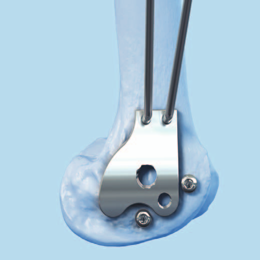 Técnica quirúrgica 4 Reducción de la superficie articular Instrumentos 310.990 Avellanador grande, longitud 180 mm, para tornillos de cortical de 4.5 mm 324.