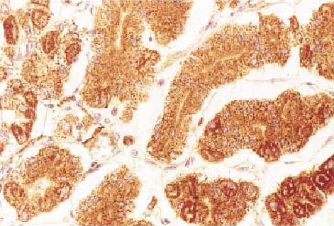 EPO-R in cancer EPOR expression corellates with histopathological grade in gastric cancer normal gastric mucosa gastric cancer tumor