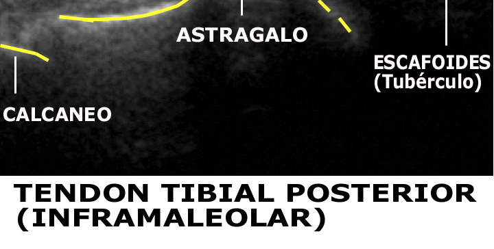 Exploración Medial de tobillo: Imagen Longitudinal Distal Existe anisotropia por
