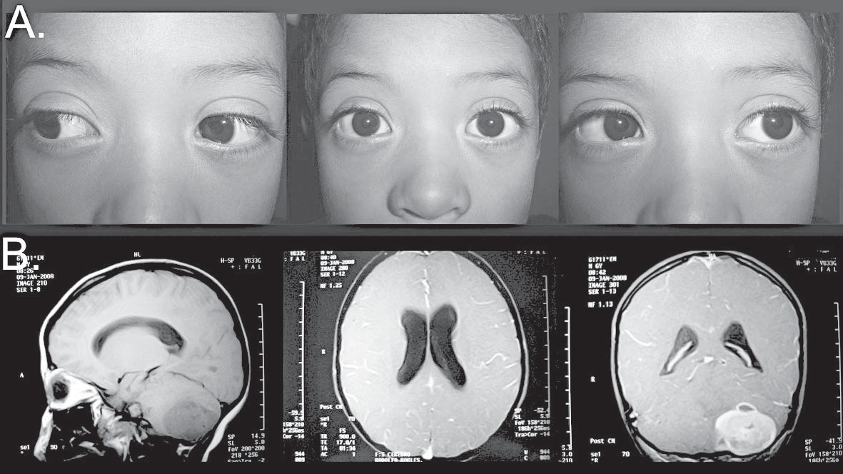 450 / Arch Argent Pediatr 2008;106(5):443-457 / Comunicaciones breves Tercer paciente Niña de 2 años y 8 meses, traída a consulta por desviación del ojo izquierdo.