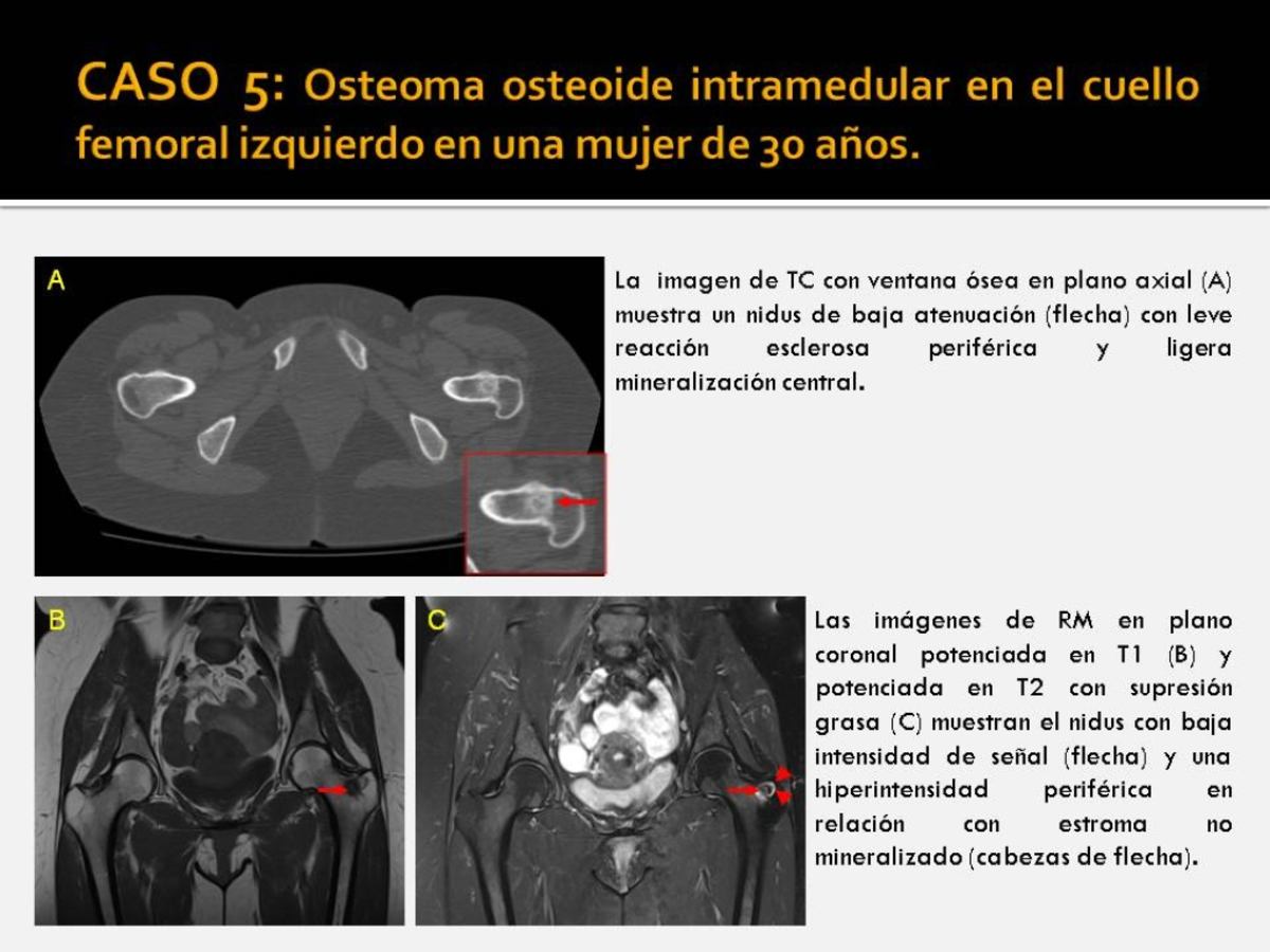 Fig. 5: Osteoma osteoide intramedular en el cuello