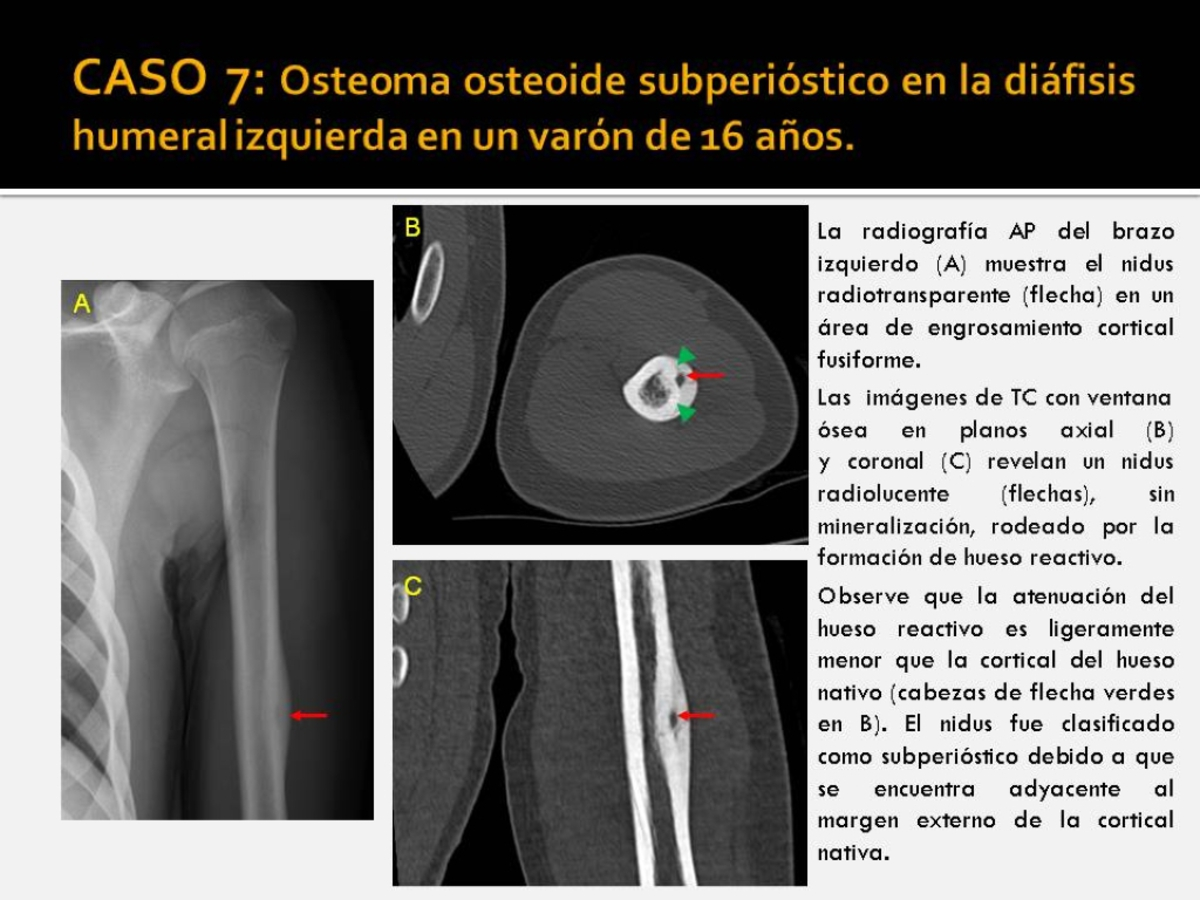 Fig. 7: Osteoma osteoide subperióstico en la diáfisis