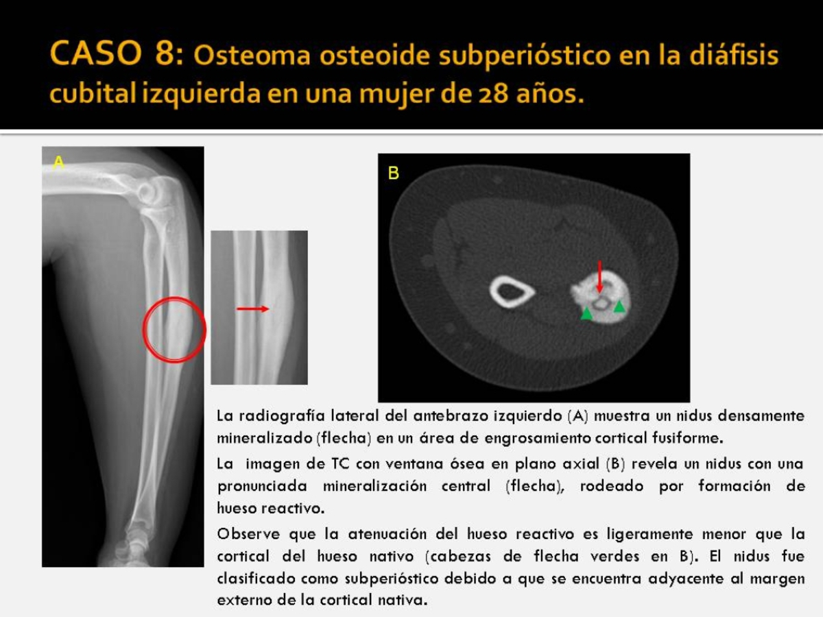 Fig. 8: Osteoma osteoide subperióstico en la diáfisis