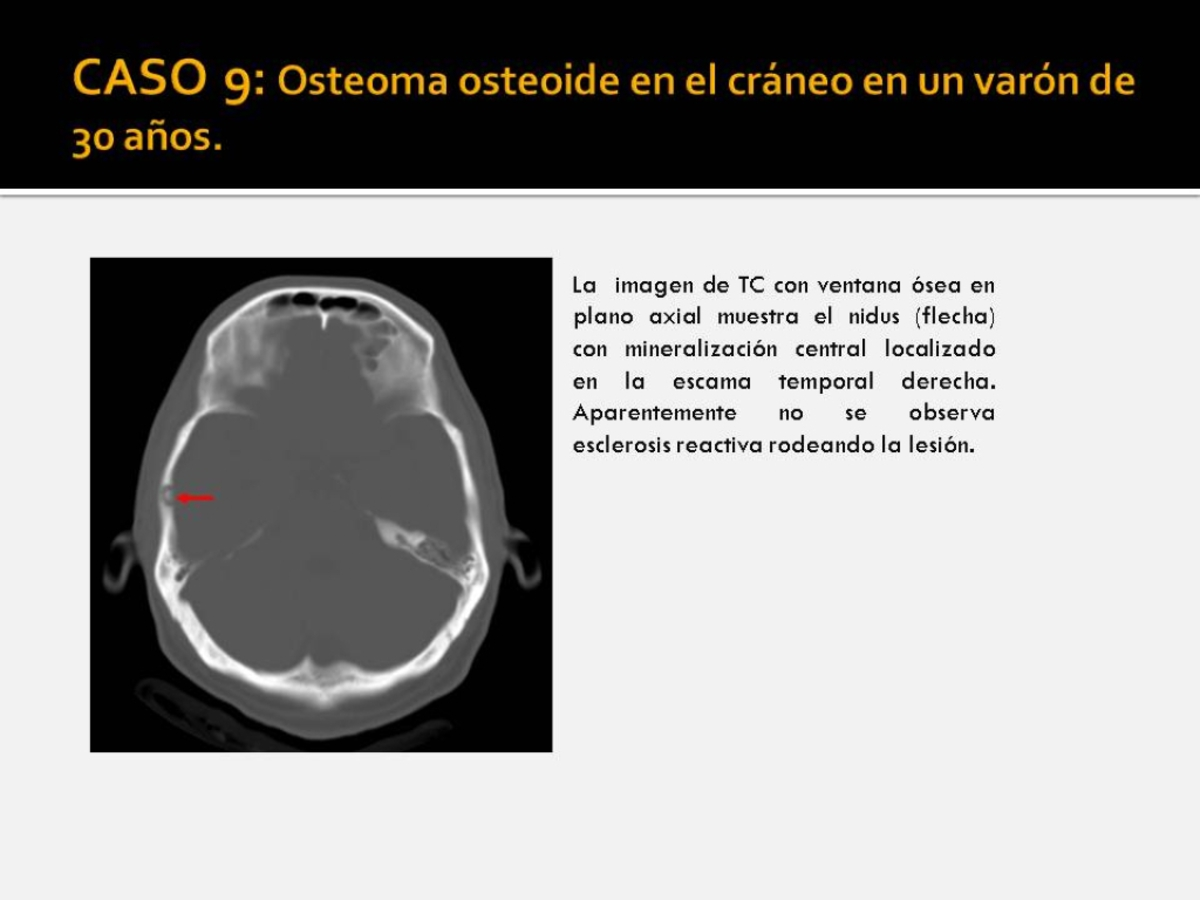 Fig. 9: Osteoma osteoide en el cráneo