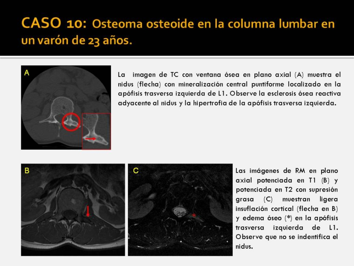 Fig. 10: Osteoma osteoide en la columna