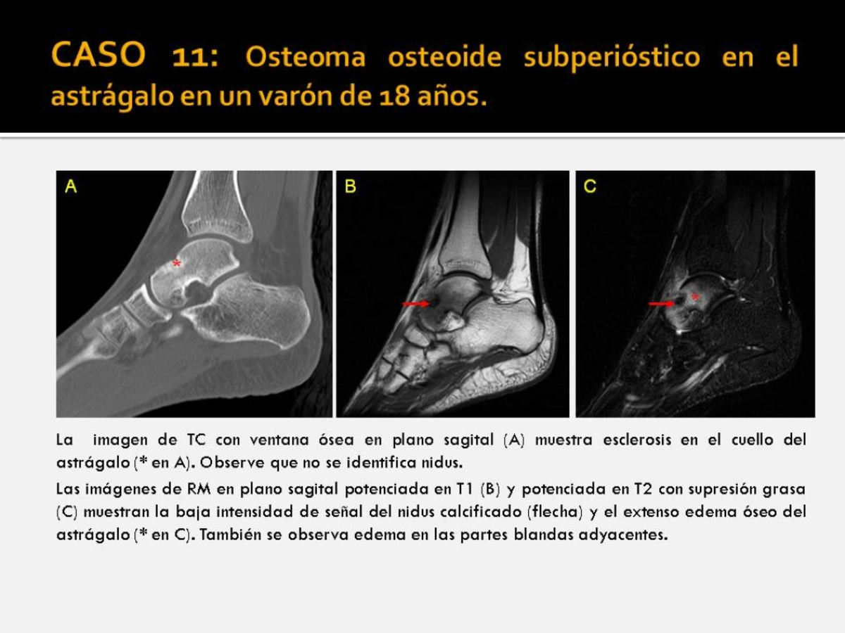 Fig. 11: Osteoma osteoide subperióstico en el