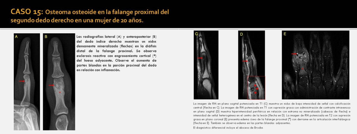 Fig. 14: Osteoma osteoide en la falange media del segundo dedo izquierdo en un varón de 17 años. Fig.