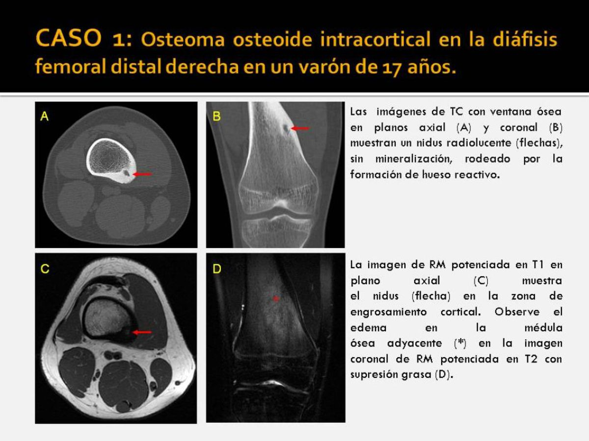 El absceso intracortical y el osteoma osteoide a menudo son indistinguibles en la radiografía convencional.