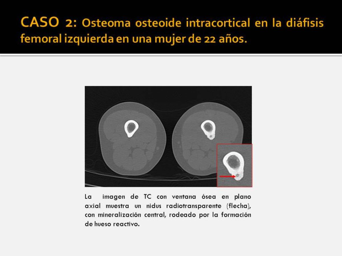 Fig. 2: Osteoma osteoide intracortical en la diáfisis
