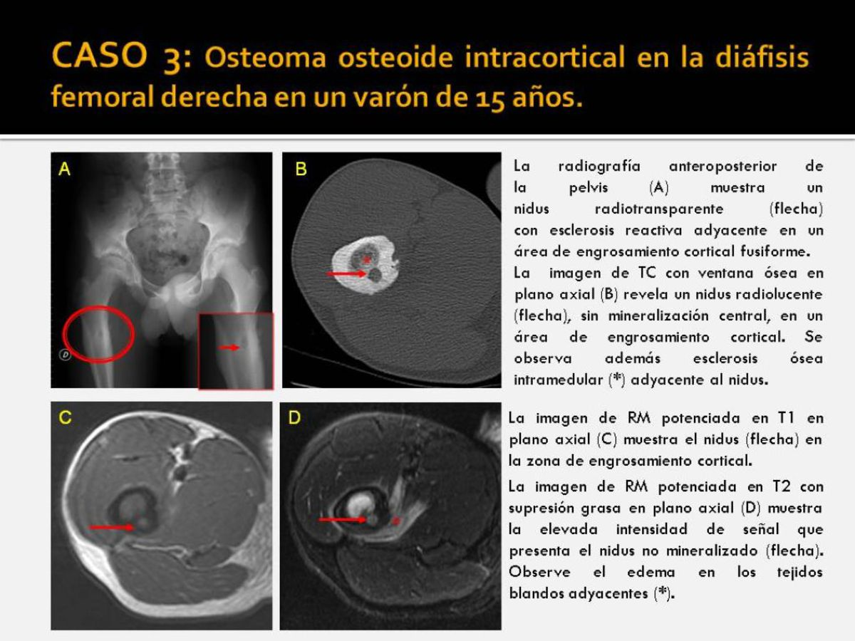 Fig. 3: Osteoma osteoide intracortical en la diáfisis