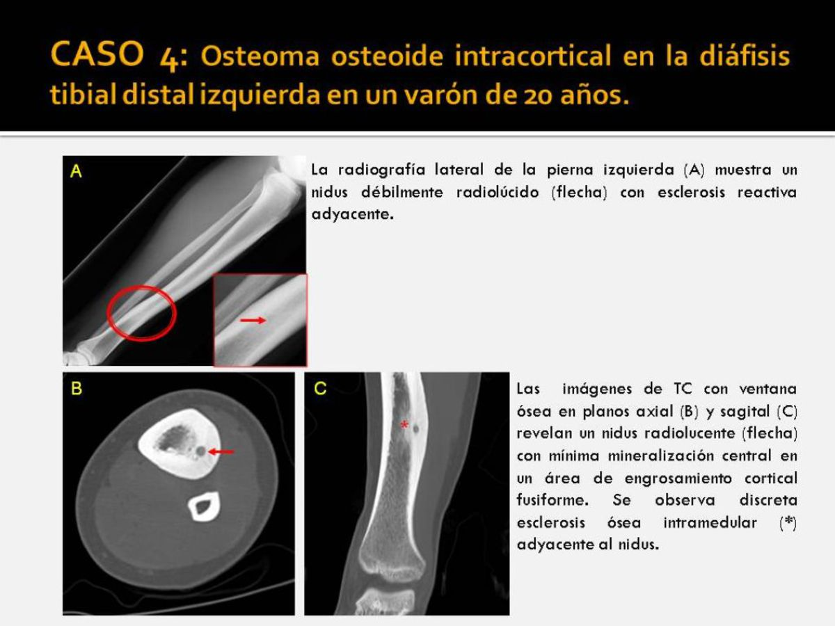 Fig. 4: Osteoma osteoide intracortical en la diáfisis