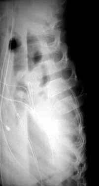 Tejeda Barreras M. Clasificación de fracturas toracolumbares Figura 2. Rx AP de fractura por estallido. La fractura por flexodistracción es conocida comúnmente como «lesión por cinturón de seguridad».