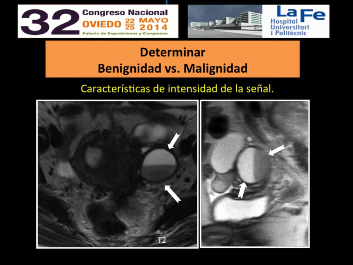 Fig. 3: Imágenes de Endometriomas. Las Imagen potenciadas en T2 axial ambas lesiones muestran típico signo del "sombreado".