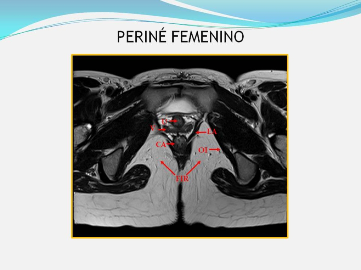Fig. 1: La imagen de resonancia magnética en plano axial potenciada en T2 muestra la anatomía normal del periné femenino en un corte a nivel