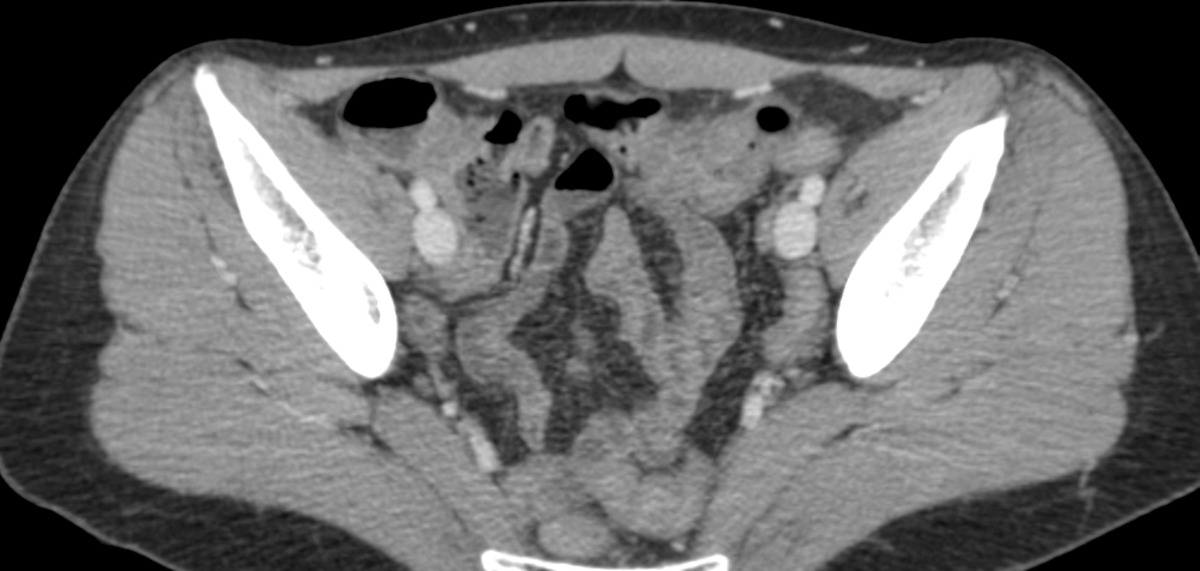 Fig. 7: Fig. 7: Imagen axial de TC de abdomen con contraste iv, que muestra engrosamiento circunferencial de la pared del colon transverso y aumento de atenuación de la grasa adyacente.