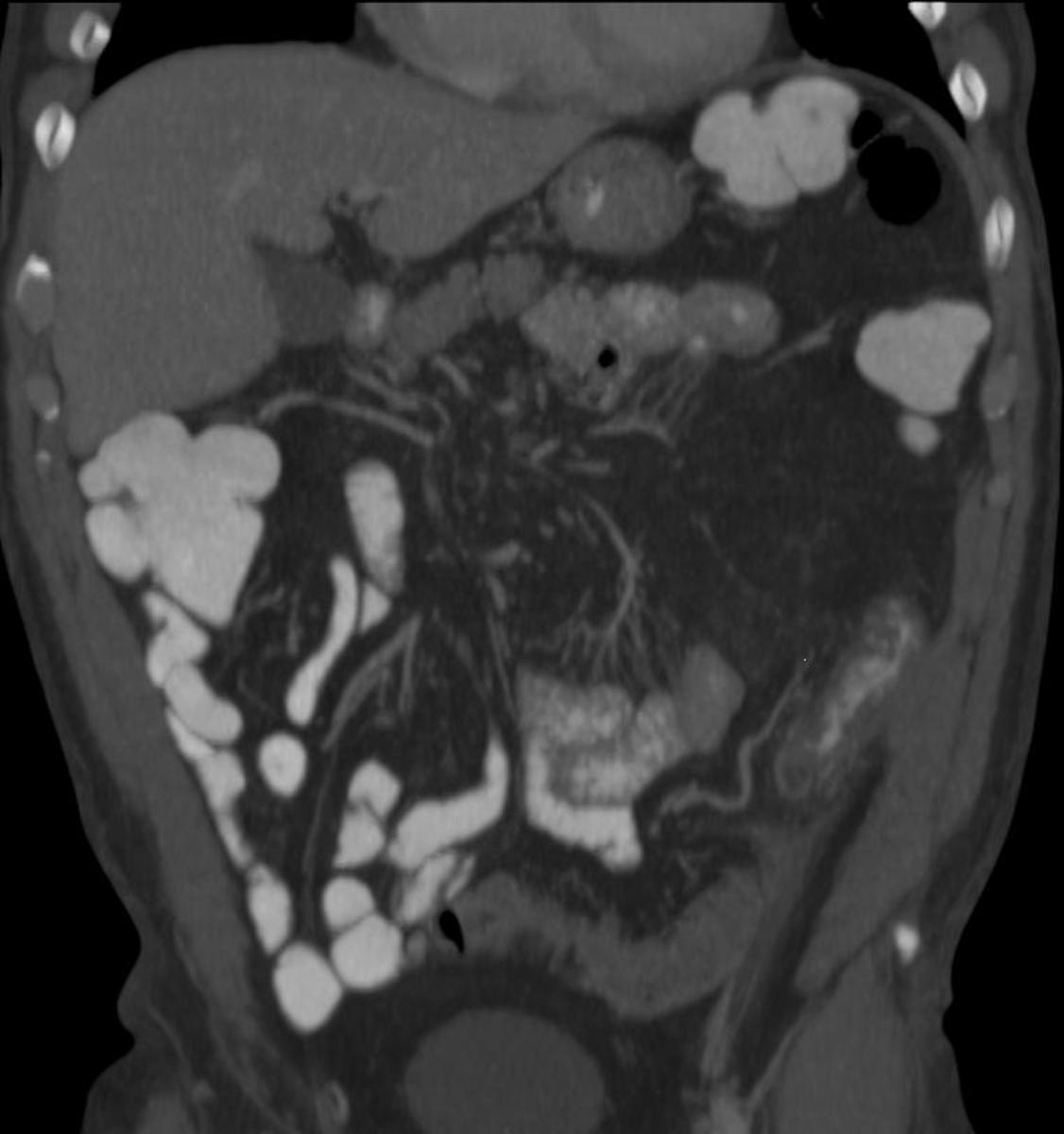 Fig. 3: Fig. 3: Imagen coronal-oblicua de TC de abdomen con contraste oral e iv.