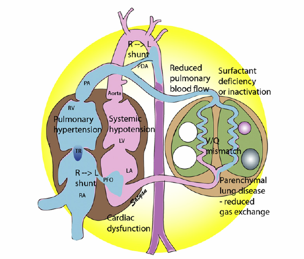 Mecanismos de hipoxemia Satyan