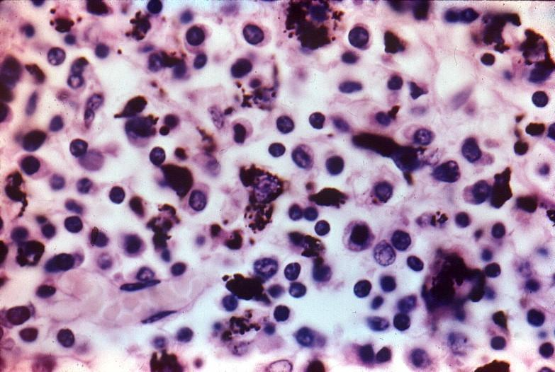 Tejido conjuntivo común: Células inmigrantes Los macrófagos son otro ejemplo de célula inmigrante del tejido conjuntivo que