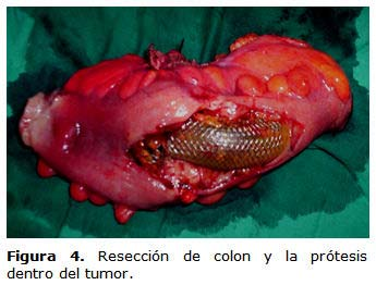 Resultado anatomopatológico: adenocarcinoma de colon moderadamente diferenciado. DISCUSIÓN La obstrucción aguda del colon forma parte del síndrome de abdomen agudo y debe resolverse con urgencia.