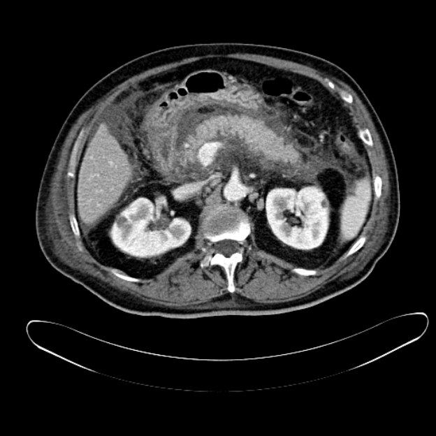 1 Pancreatitis grave con colecciones. En ecografía en modo B, se observa un área hipoecoica anterior al cuerpo del páncreas (1).