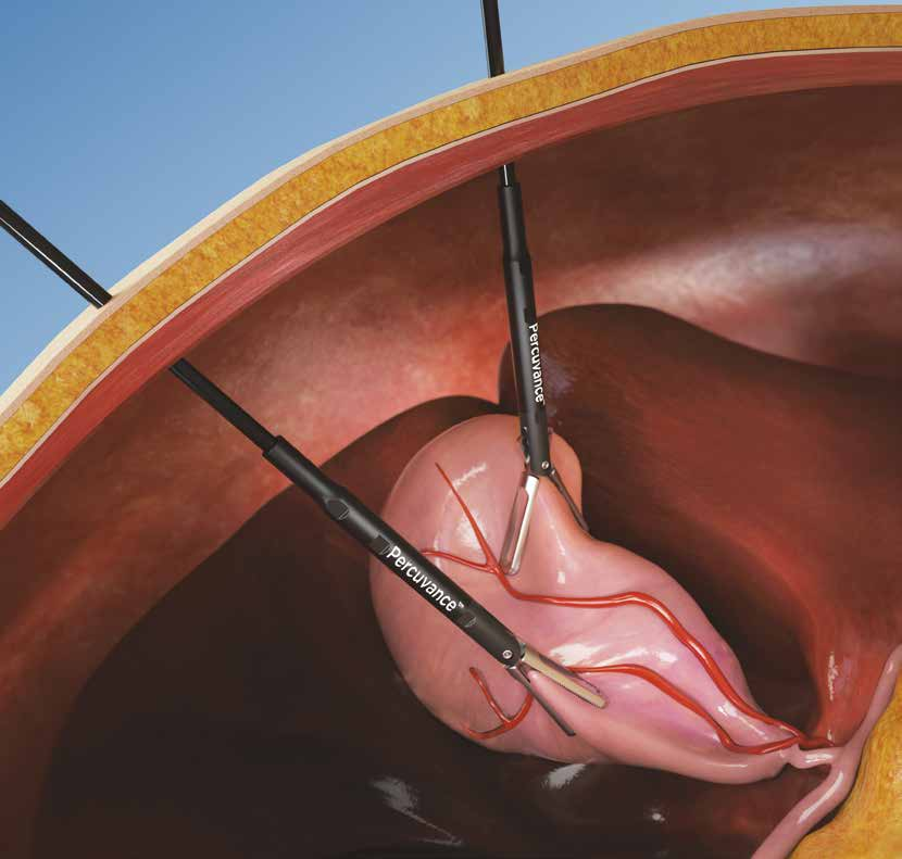 El Sistema Quirúrgico Percutáneo Percuvance de 2,9 mm