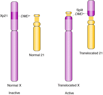 TRANSLOCACION RECIPROCA TRANSLOCACION RECIPROCA: Cromosomas: 21 y X El alelo DMD+ se torna no funcional debido a