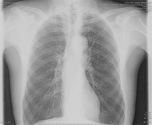Imágenes radiolúcidas Hiperinflación pulmonar
