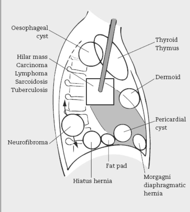 Vascular Hernia