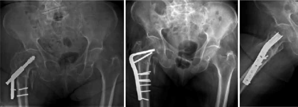 El objetivo de este estudio fue evaluar los resultados clínicos y radiológicos de seudoartrosis de fracturas intertrocantéricas de cadera con el uso de fijación con clavo-placa (AO/ASIF) combinada